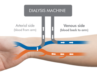 Diagram showing the interaction between patient and the dialysis machine