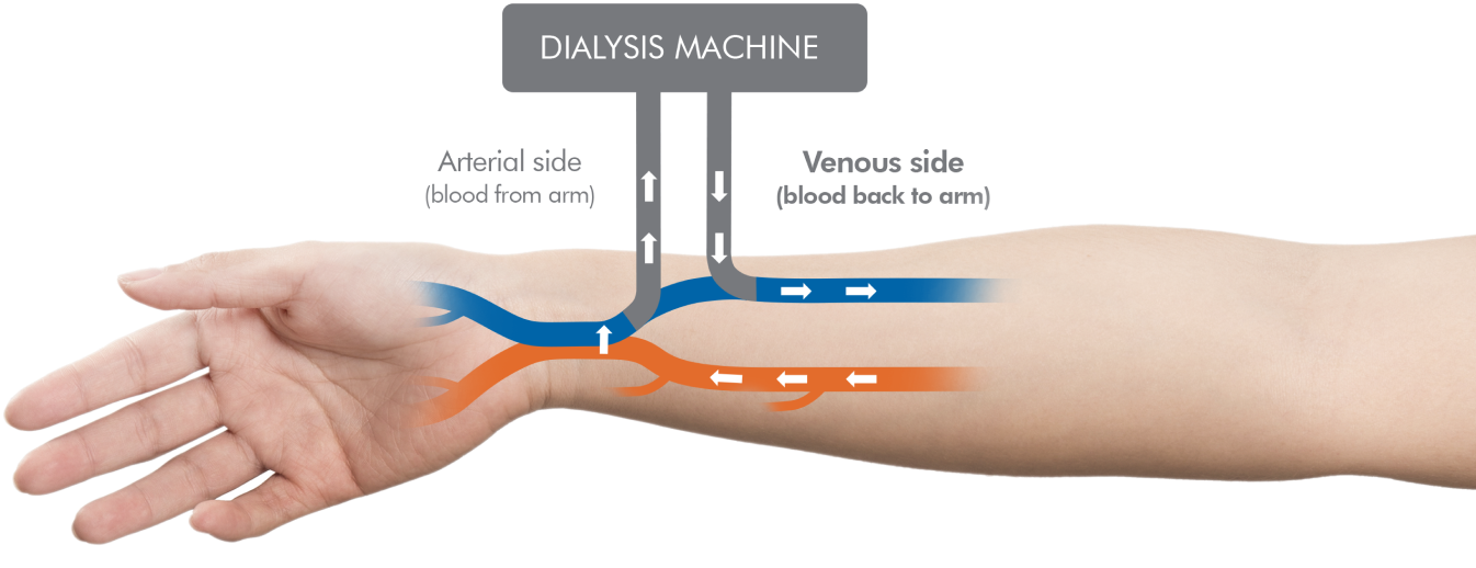 Diagram showing the interaction between patient and the dialysis machine